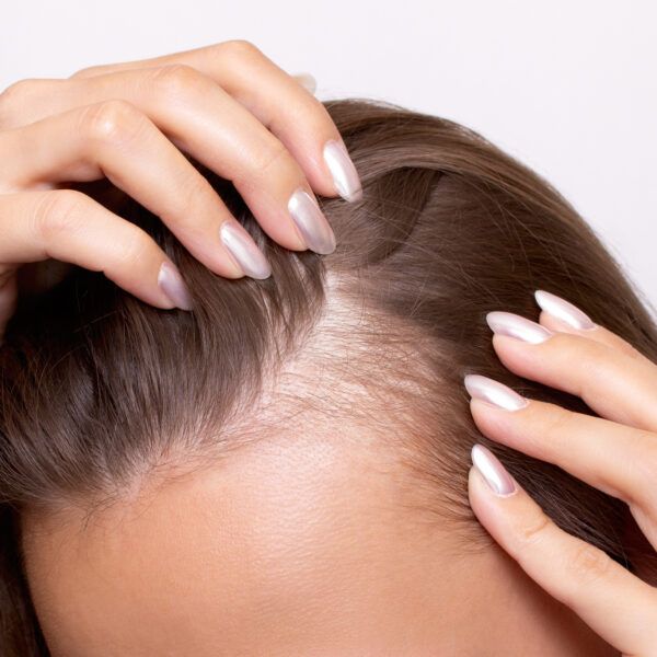 Problem nadmiernego wypadania włosów